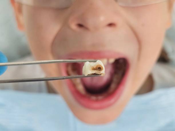 Best Emergency Root Canal Treatment in Summerfield, MD